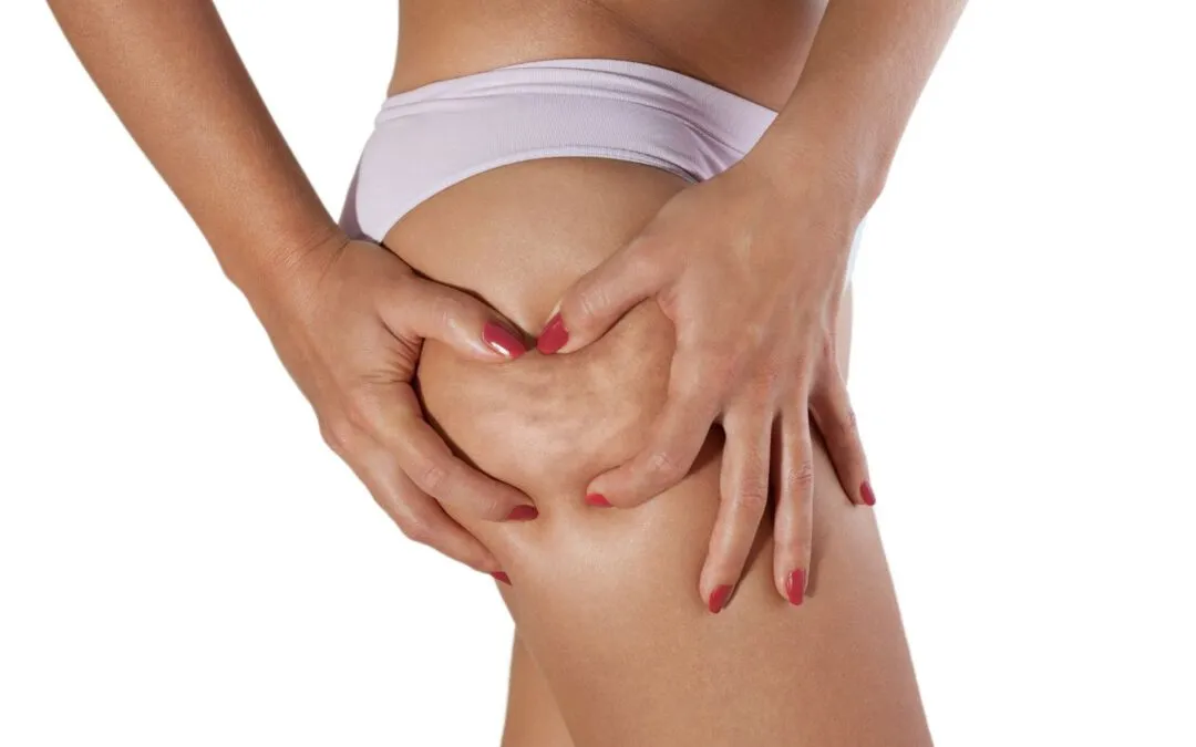 Cellulite: Was können Sie gegen die Orangenhaut unternehmen?
