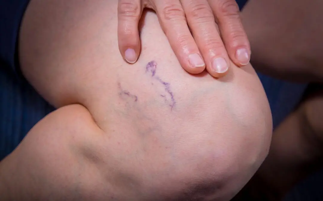 Venenpumpe – so halten Sie Ihre Venen fit