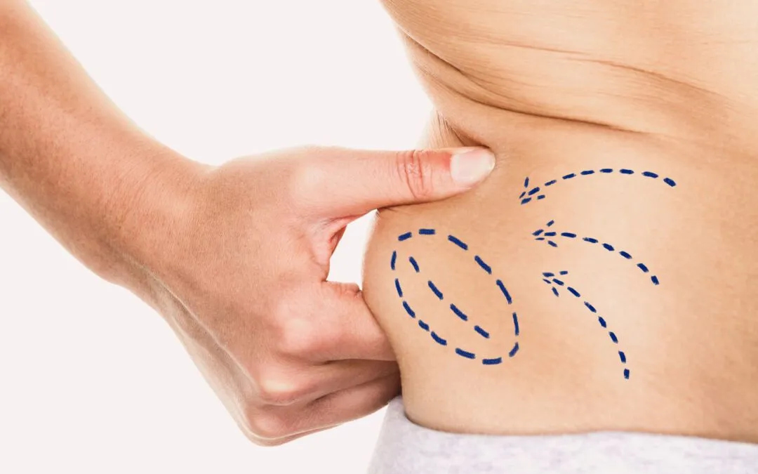 Fettabsaugen bei Celluliten