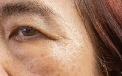 Die 5 besten Lebensmittel gegen Altersflecken: Wissenschaftlich fundierte Anti-Aging-Tipps